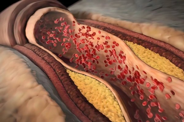 Is pyrosterol always too high? Cardiologists recommend drinking 